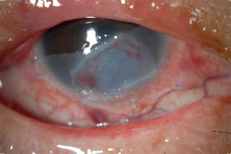 AMT | Wills Eye Hospital
