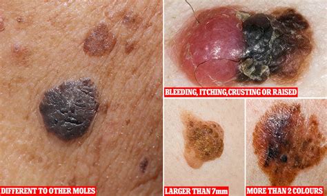 Fotos Do Cancro Mole - Cancerous Moles That Are Different How To Tell If A Mole Is Cancerous: