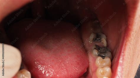 bad tooth decay