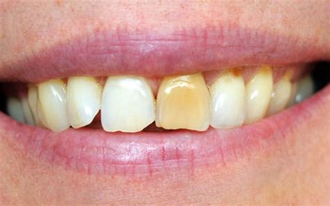 Brown Stains On Teeth: Causes and Treatment in Bassendean