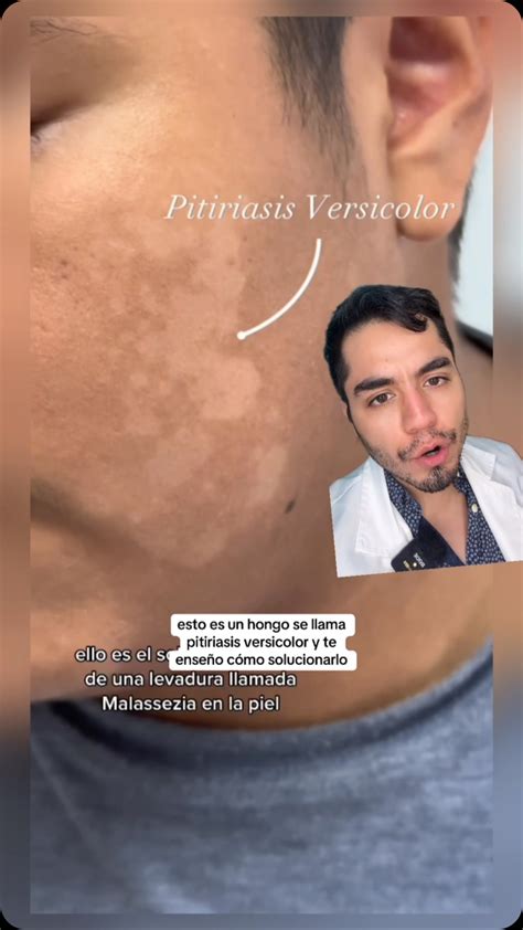 Dermatólogos Online | #tiña #hongo #tiñacorporis | Instagram