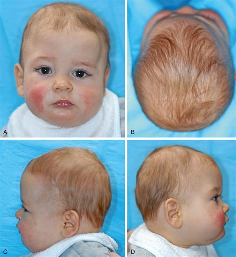 Multiple Suture Nonsyndromic Craniosynostosis - Clinical Tree