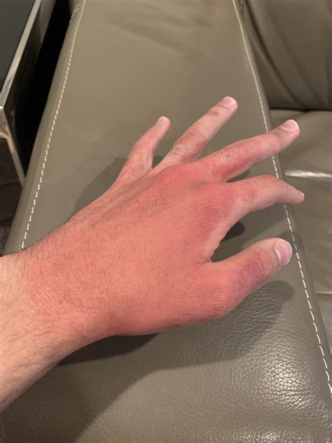 I recently cleared up from my eczema. The past few days my hand has