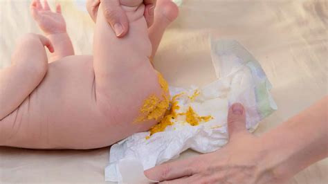 Fezes De Bebê Com Intolerância À Lactose - Grumos nas fezes do bebê: o que significa, e quando se preocupar