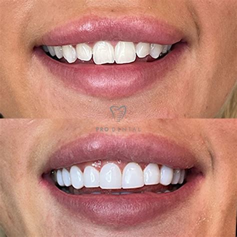 Composite bonding transformation | Cosmetic teeth, Composite veneers ...