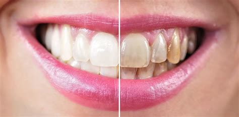 how much does it cost to whiten teeth at dentist
