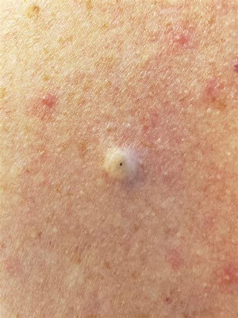 Epidermoide
