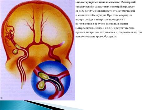 Аневризма сосудов головного мозга - презентация онлайн