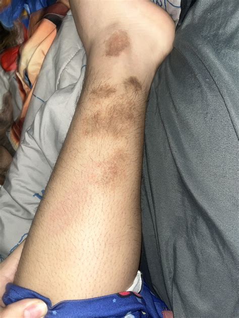 i've had these growing on me since over 9 yrs ago when i was little so