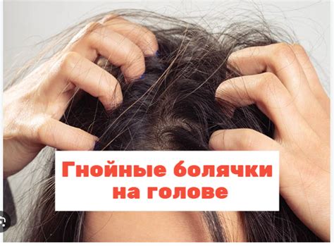 Гнойные болячки на голове в волосах: причины, чем мазать