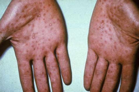 Syphilis: Symptoms, Treatment, and Prevention