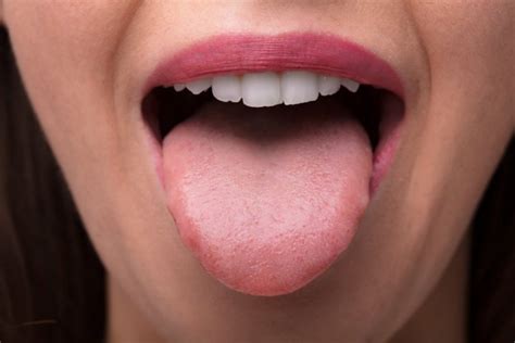 HPV Bumps On Your Tongue - HPV Hub, LLC