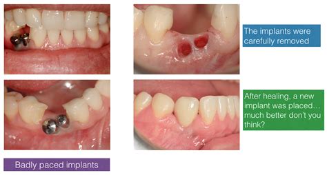 Correction of Bad Implants | The Dental Implant Clinic