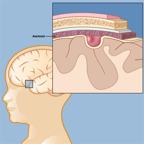arachnoid cyst fetal health foundation