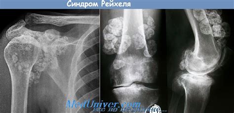 Синдром Рейхеля (Reichel) - синонимы, авторы, клиника