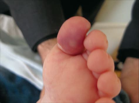 Blue Toe Syndrome as a Complication of Intra-arterial Chemotherapy for ...