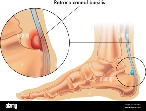 achilles tendon   human foot stock vector images alamy