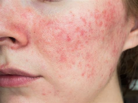 Looking into Rosacea and Vitamin Deficiency - SL Aesthetic Clinic