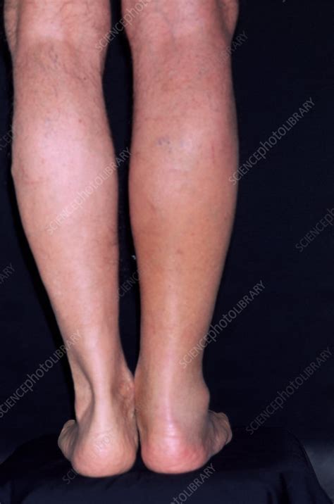 Bruised leg - Stock Image - M330/1271 - Science Photo Library