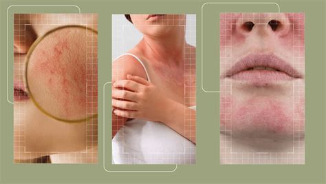 Skin Redness – Faasha