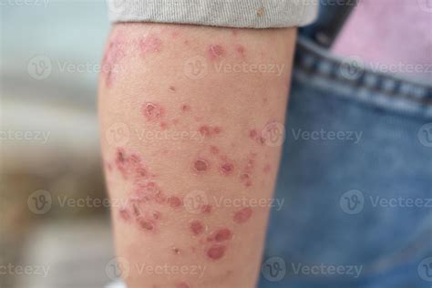Hand foot and mouth disease a rash of painful blister and dry scaly