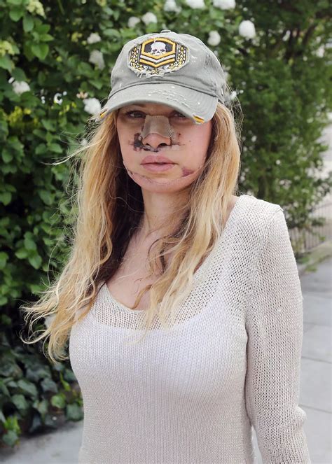 Shocking pictures of Alicia Douvall after plastic surgery - The Mirror