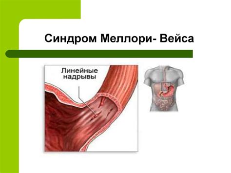 Заболевания желудка и двенадцатиперсной кишки. Лекция №3 - презентация ...