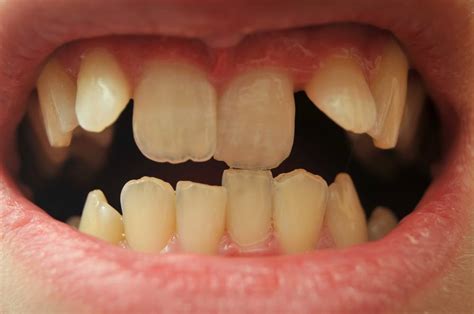 Sonhar Com O Dente Torto - O que significa sonhar com dente torto? - Dreams - Sonhar com ...