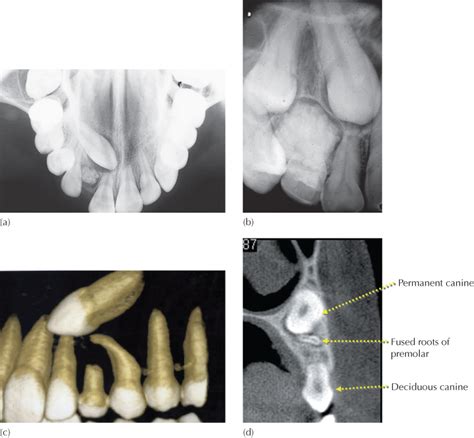 palatally impacted canines pocket dentistry