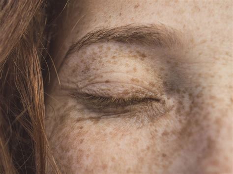 Types of benign spots that can form on your skin - Padeye
