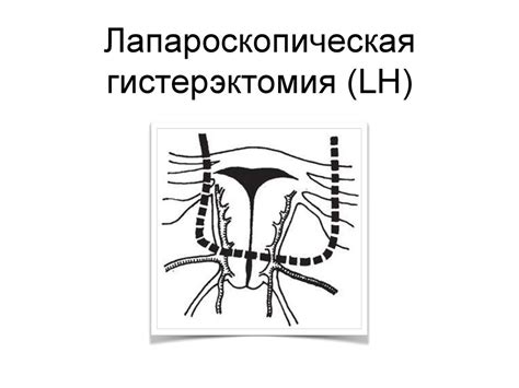 Гистерэктомия. Современная хирургическая тактика - презентация онлайн