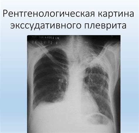 Пневмония на рентгене: как выглядит воспаление легких на рентгеновском ...