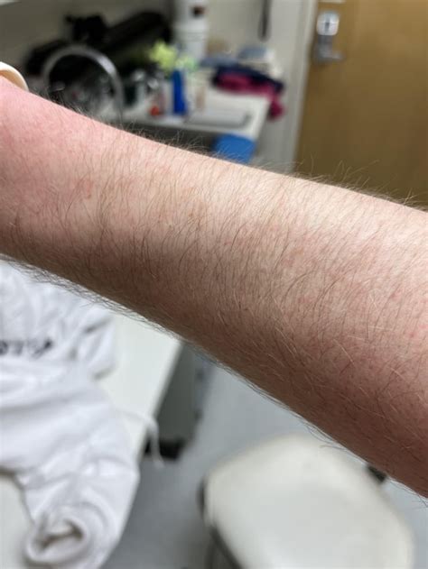 Itchy red skin : r/Skincare_Addiction