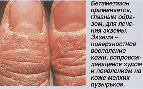Бетаметазон — местный кортикостероид (Лекарства - Гормоны и их ...