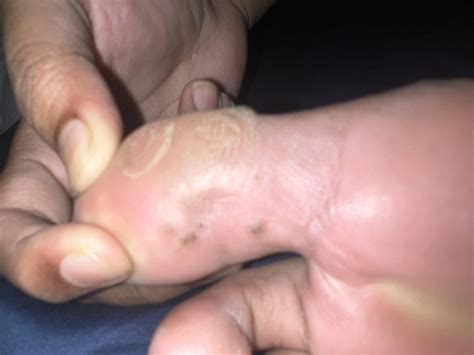 Are these plantar warts? : r/Warts