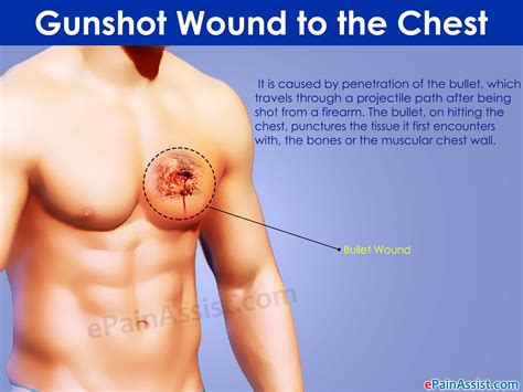 Gunshot Wound to the Chest