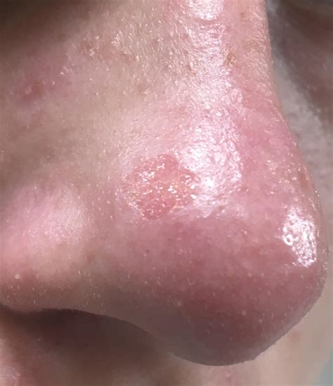 Sunburn Blisters Nose