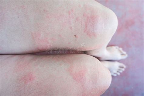 Skin Rash, Rashes Caused by Allergic Reactions Stock Image - Image of ...