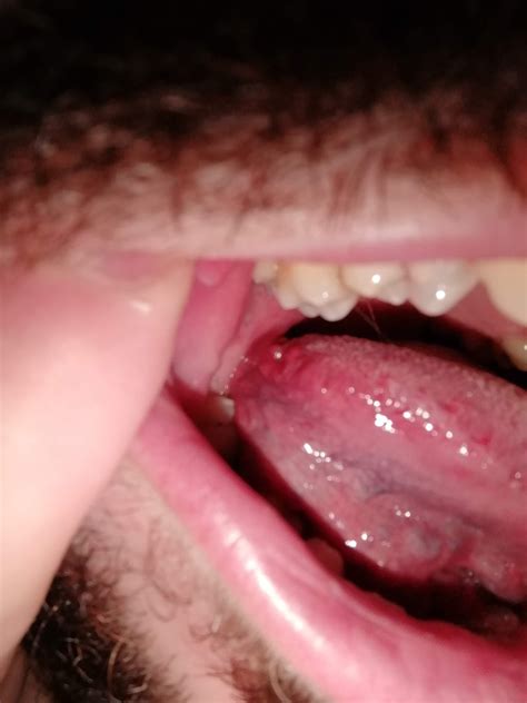 Bumps On Side Of Tongue