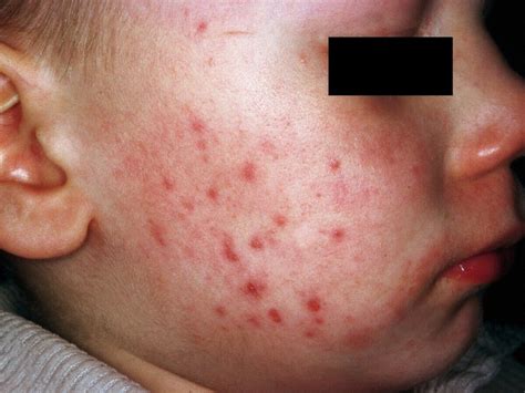 Infantile Acne