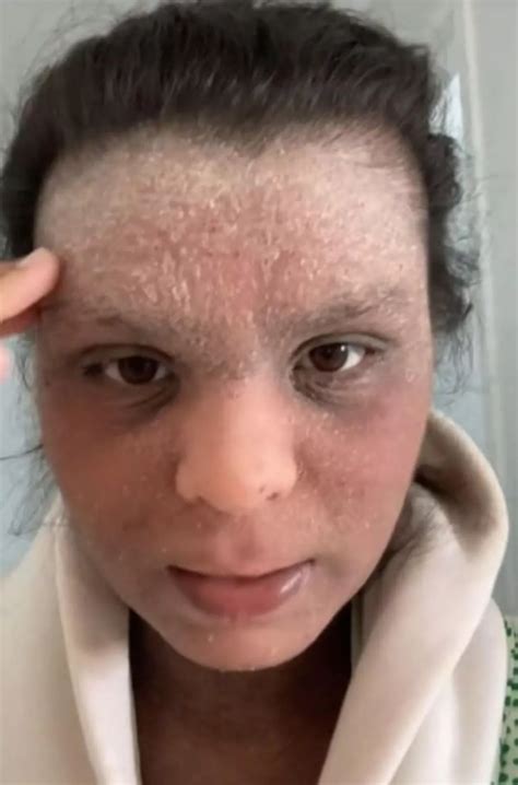 'Pain of steroid cream prescribed for my eczema was worse than
