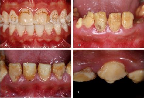 How to Understand Amelogenesis Imperfecta – Devidental