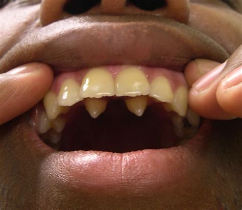 How Freddie Mercury got his voice: It wasn't his teeth - Genetic ...