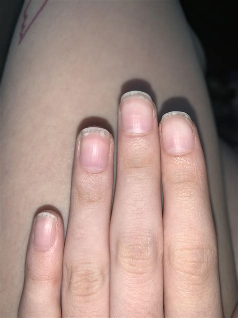 What Do The Little White Spots On Nails Mean - Design Talk