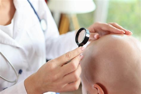 Scientists confirm the connection between balding and skin cancer - The