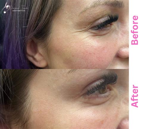 Botox Before And After Picture | Tucson, AZ