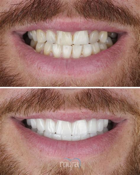 GET NEW TEETH IN TURKEY | DENTAL CENTRE TURKEY | Dental treatment ...