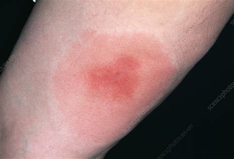 Infected bee sting - Stock Image - M320/0351 - Science Photo Library