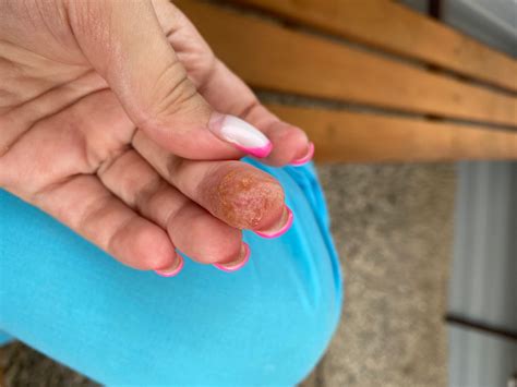 Пузырьки водянистые - Вопрос дерматологу - 03 Онлайн