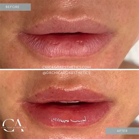 Hydrafacial Lip Perk | Chicago Aesthetics Med Spa